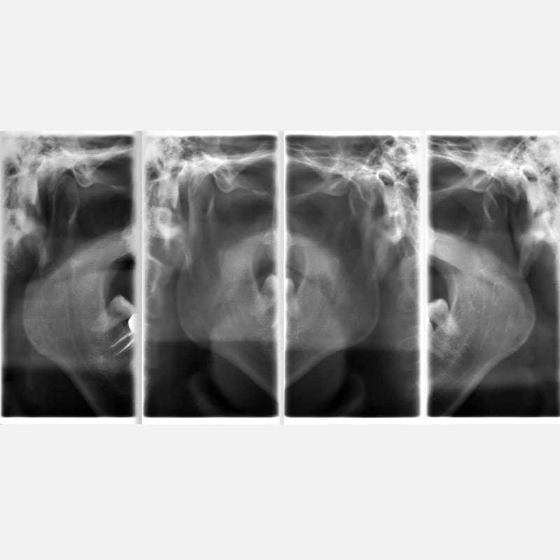 Tiếp xúc gấp 4 lần định vị chụp TMJ